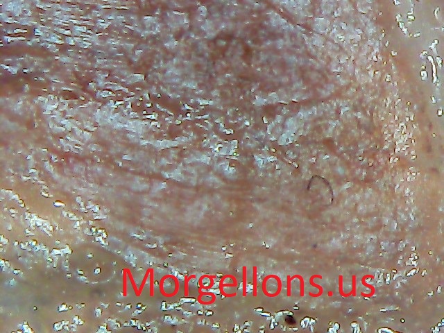 Aspergillus Fumigatus A living hell – Morgellons Disease the silent Pandemic